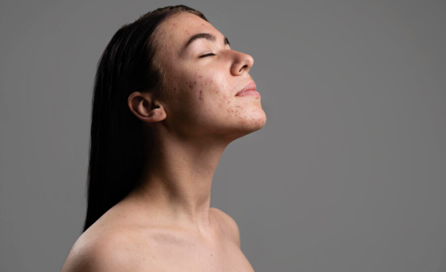 visage de jeune femme avec cicatrices d'acne et boutons d'acne