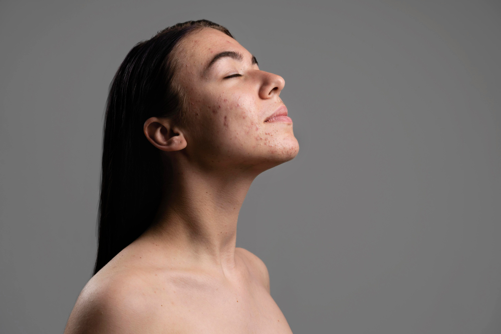 visage de jeune femme avec cicatrices d'acne et boutons d'acne